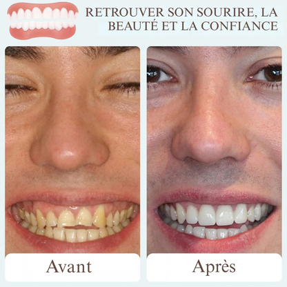 Prothèse dentaire cosmétique amovible - une apparence soignée au quotidien