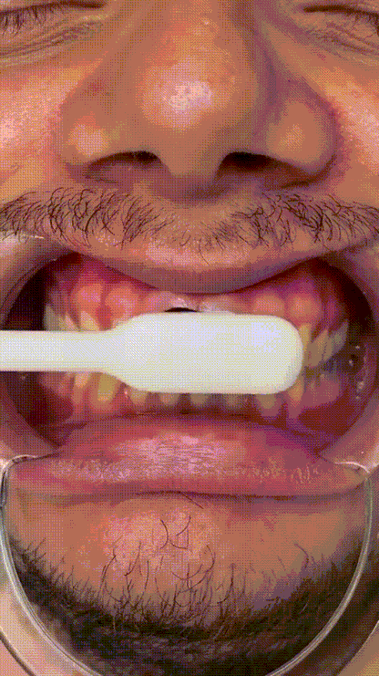 Sérum Blanchissant V34 – Sourire Plus Blanc, Sans Produits Agressifs | RONDOR