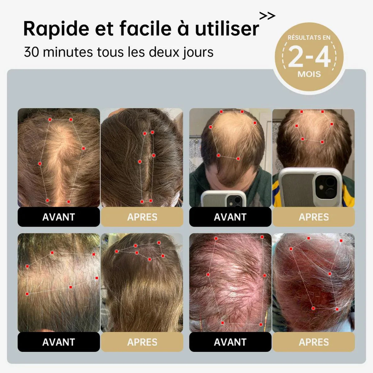 Bonnet Capillaire de Luminothérapie – Stimule la Croissance des Cheveux - Rondor