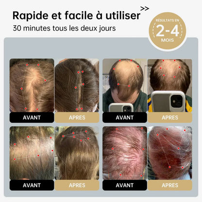 Bonnet Capillaire de Luminothérapie – Stimule la Croissance des Cheveux - Rondor