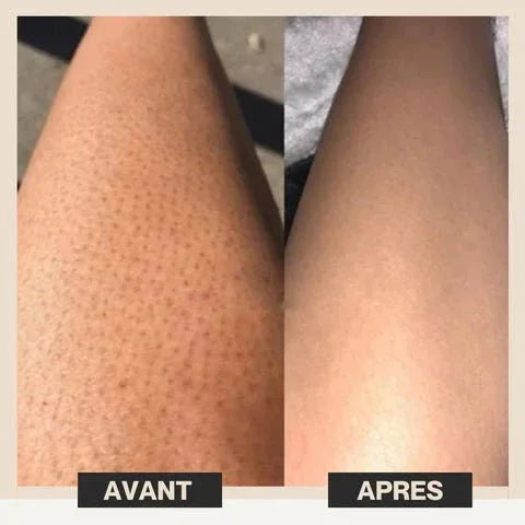 Épilateur Laser Pro à Lumière Pulsée - LumiSmooth™ - Rondor