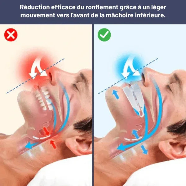 Gouttière anti - ronflement réglable SilentNight - Rondor