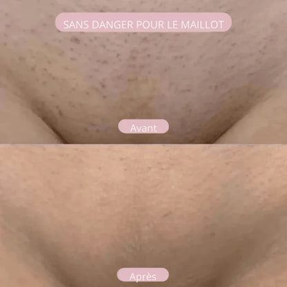 NuitLisse™ Épilation sans douleur pour une peau parfaitement lisse - Rondor