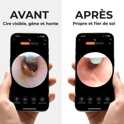 Otoscope - Nettoyeur d'oreille avec caméra intéfrée - Rondor