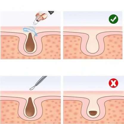 PoreGlow™ Éliminateur de points noirs - Rondor