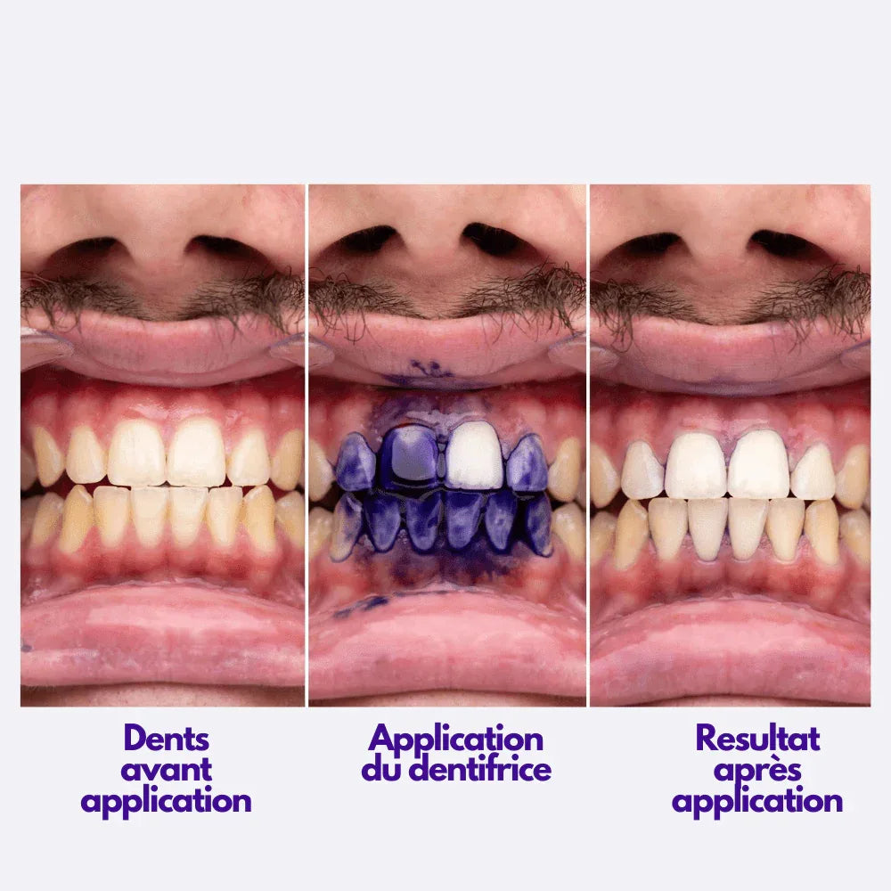 Sérum Blanchissant V34 – Sourire Plus Blanc, Sans Produits Agressifs | RONDOR - Rondor