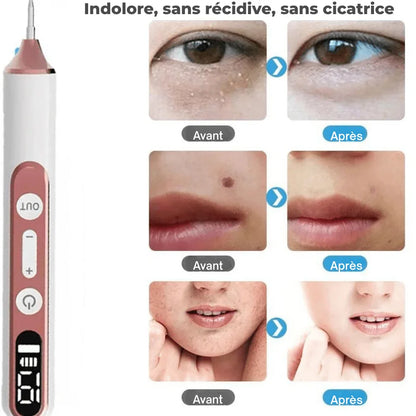 Stylo Laser Plasma Anti - taches - Rondor